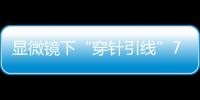 显微镜下“穿针引线”7小时！金湾这家医院成功帮患者保住断肢